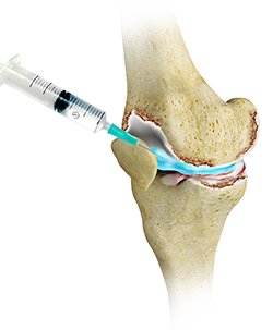 Viscosupplementation Injections        